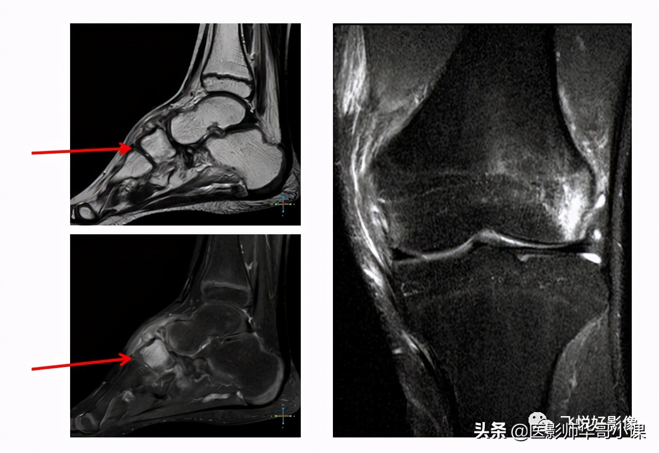 飞利浦磁共振独有技术,飞利浦磁共振减影技术