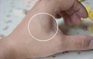 手背青筋明显是血管硬化的表现吗,血管有问题看哪个科