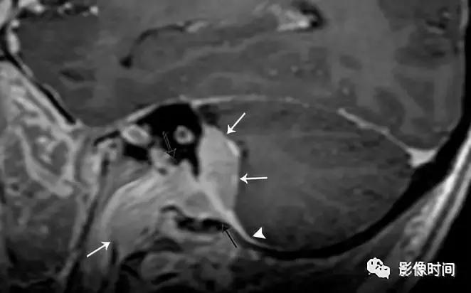 双侧颈动脉鞘间隙多发小淋巴结影,双侧颈动脉间隙多软组织密度结节