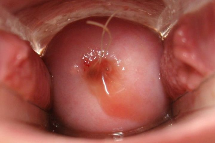 避孕环、节育环、宫内节育器,到底是个啥?