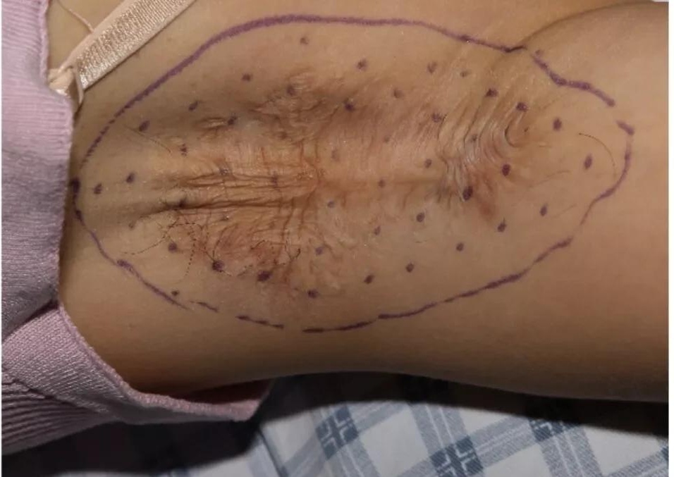 狐臭手术留下的疤痕怎么消除,狐臭手术留下的疤痕又痛又痒