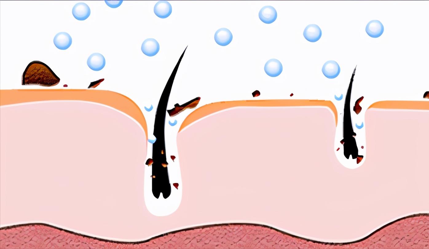 严重脱发掉头发怎么办,掉头发就是脱发吗为什么会脱发呢