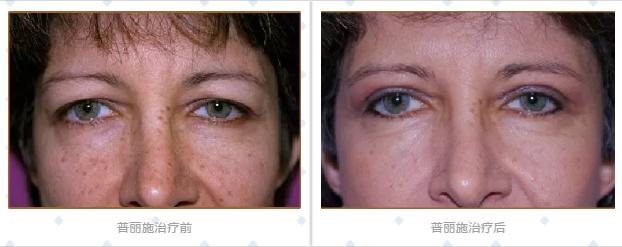 普丽施等离子仪多少钱一台,普丽施等离子