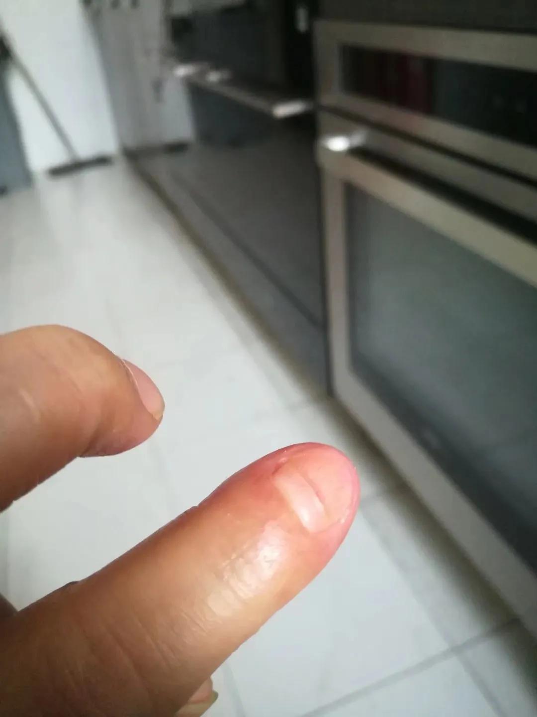 连续性肢端皮炎掉痂了是好转吗,连续性肢端皮炎需要拔指甲吗