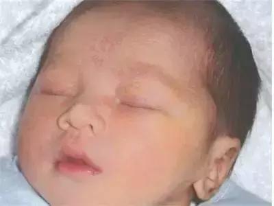 新生儿皮肤问题怎么解决,家有新生儿怎么办