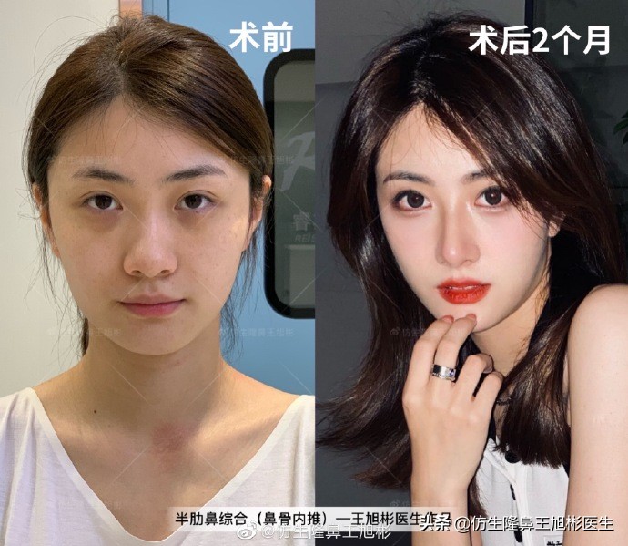 大鼻头缩小的改善原理,鼻头毛孔粗大如何改善缩小毛孔