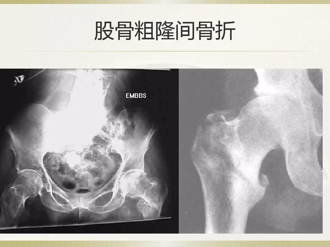 骨科x光片读片技巧,放射科骨科读片教程