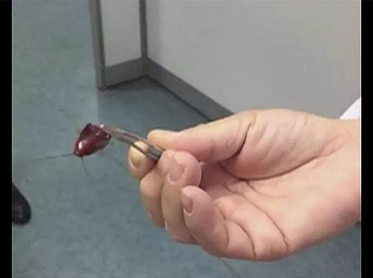 孩子耳朵里进虫子处理视频,孩子耳朵里进虫子