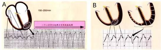 心律失常室性心动过速怎样造成的,室性心动过速最常见的病因