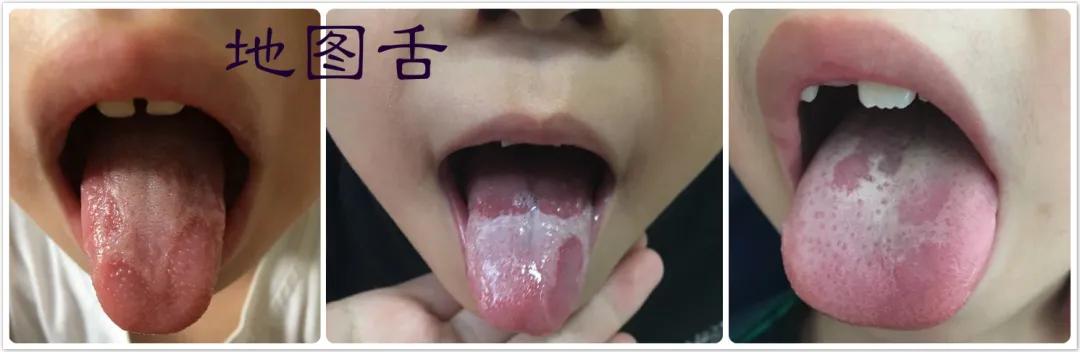 地图舌靠小儿推拿可以治好吗,小儿地图舌治疗怎么推拿