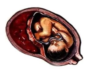 二胎妈妈突然意外血如泉涌,宝妈突然破羊水肚子痛