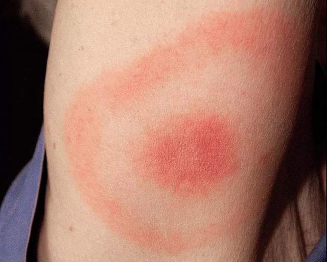 孩子被蜱虫幼虫咬了有事吗,小孩被蜱虫叮咬后怎么处理