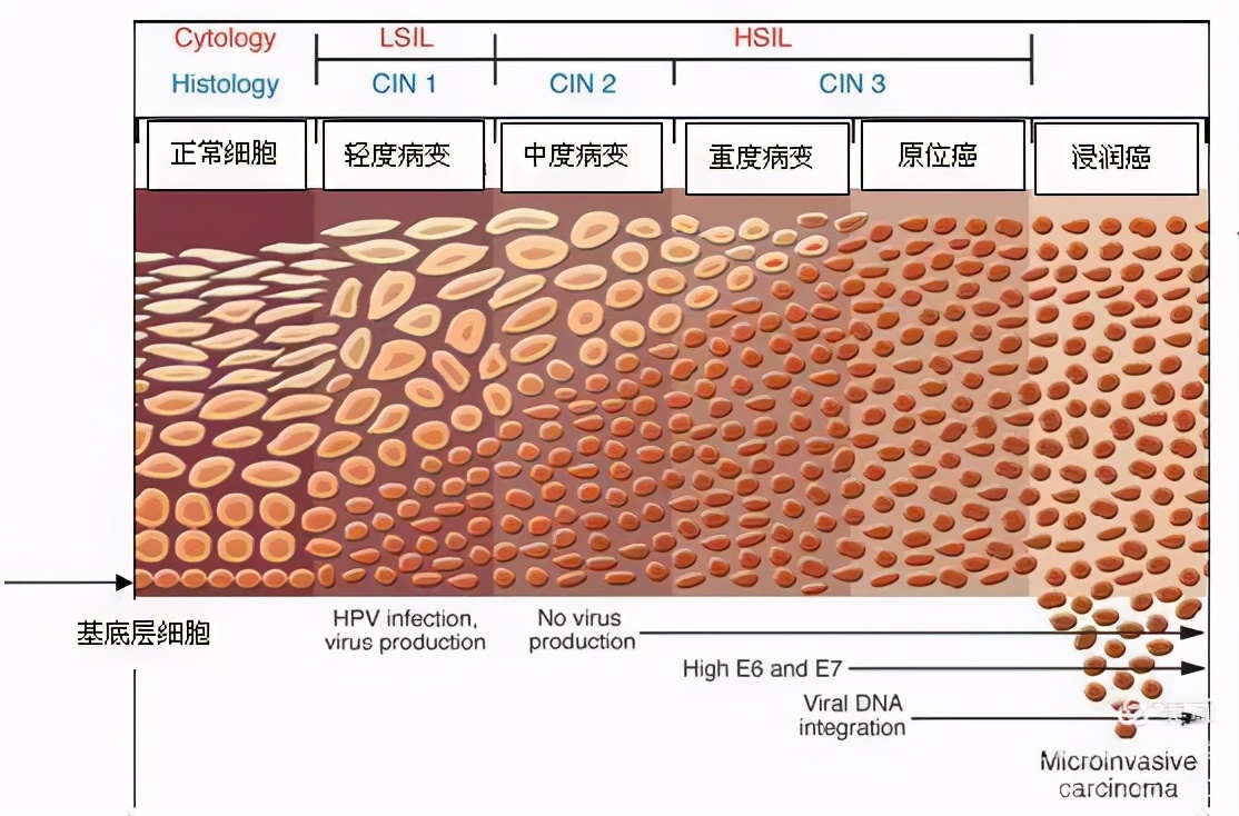 关于高危型hpv感染的视频,hpv恐慌