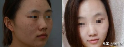 选择光电祛斑，出门再也不担心颜值掉线