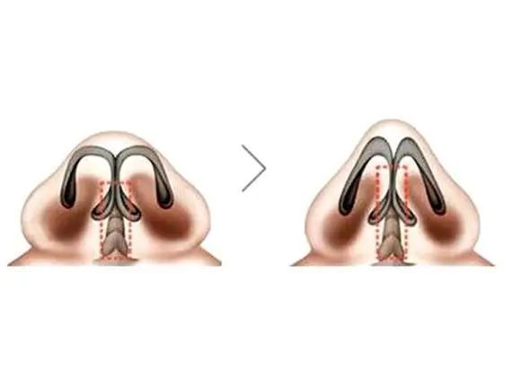 鼻翼缩小内缩和外缩的区别,鼻头缩小和鼻翼缩小是一个手术吗