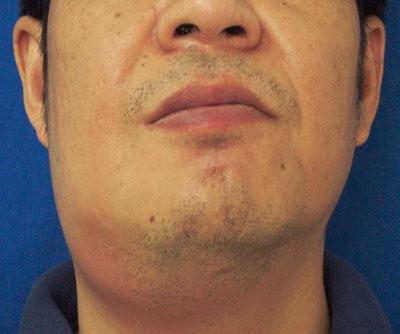 牙齿炎症治疗后牙疼,男子因为牙痛住icu