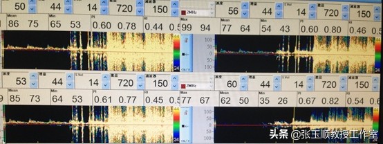 “躺平就好”四处求医愁煞人巧断病因封堵成功再登巅
