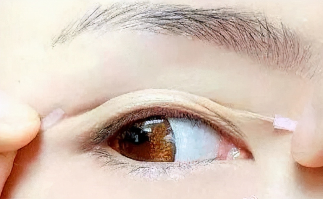 上眼皮松弛怎么锻炼,上眼皮下垂松弛严重
