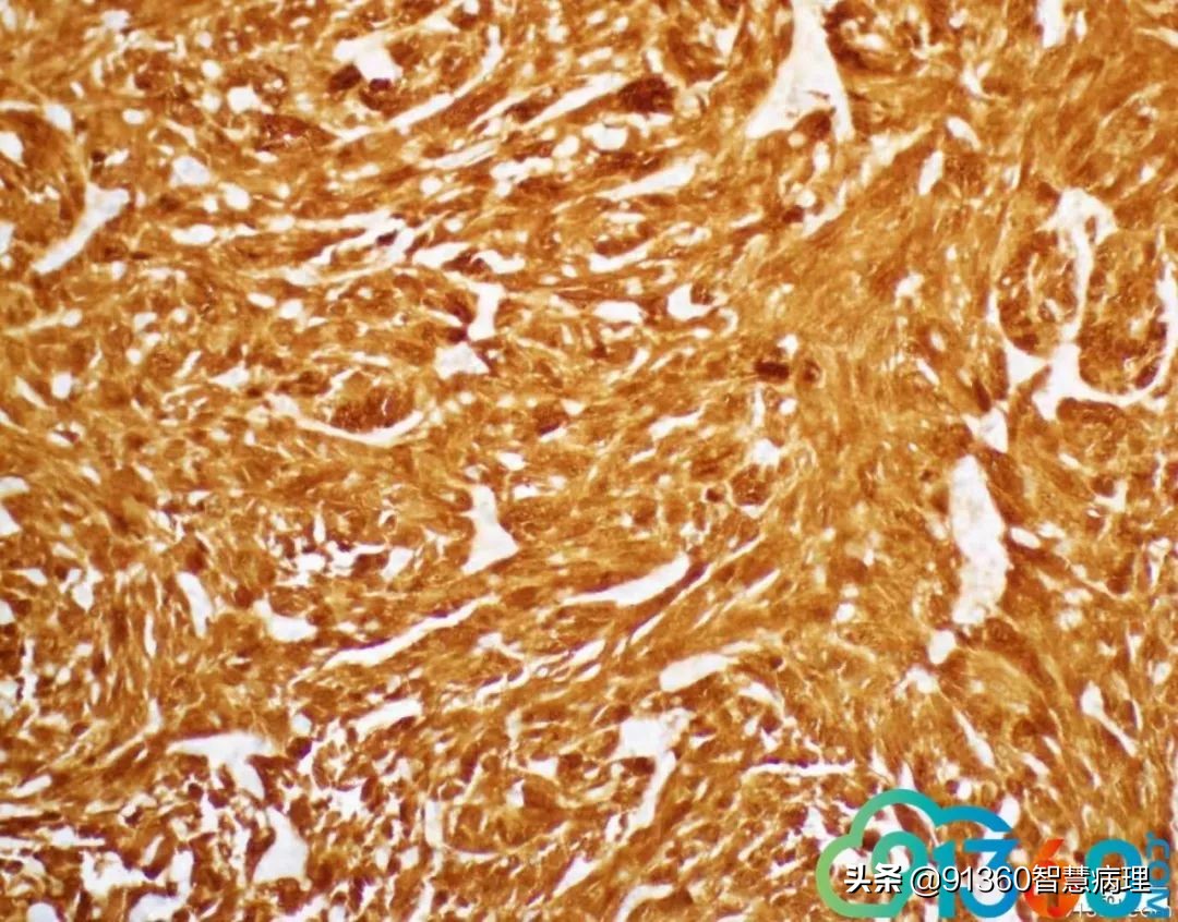 宫颈腺癌silvaa型严重吗,宫颈腺癌silvab型复发率高吗