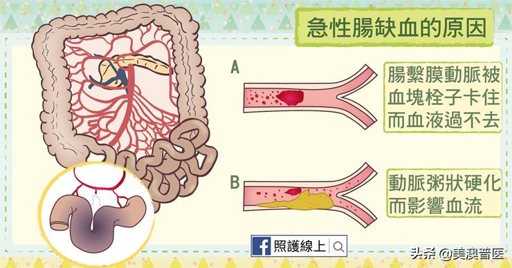 只听说过脑中风,「肠中风」是怎么回事?