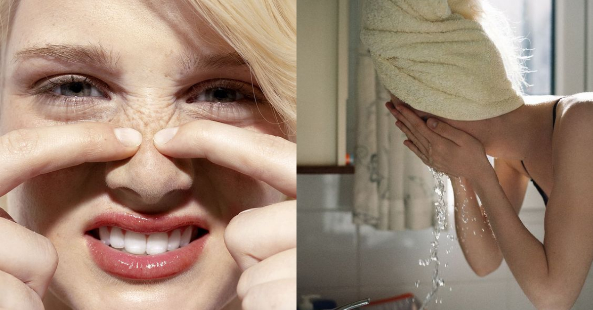 去黑头粉刺草莓鼻用什么最好,草莓鼻黑头粉刺清理神器