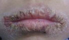 舔嘴唇会让嘴巴湿润吗,舔嘴唇嘴唇干裂怎么办