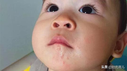 宝宝得了口水疹,宝宝得了口水疹怎么治疗