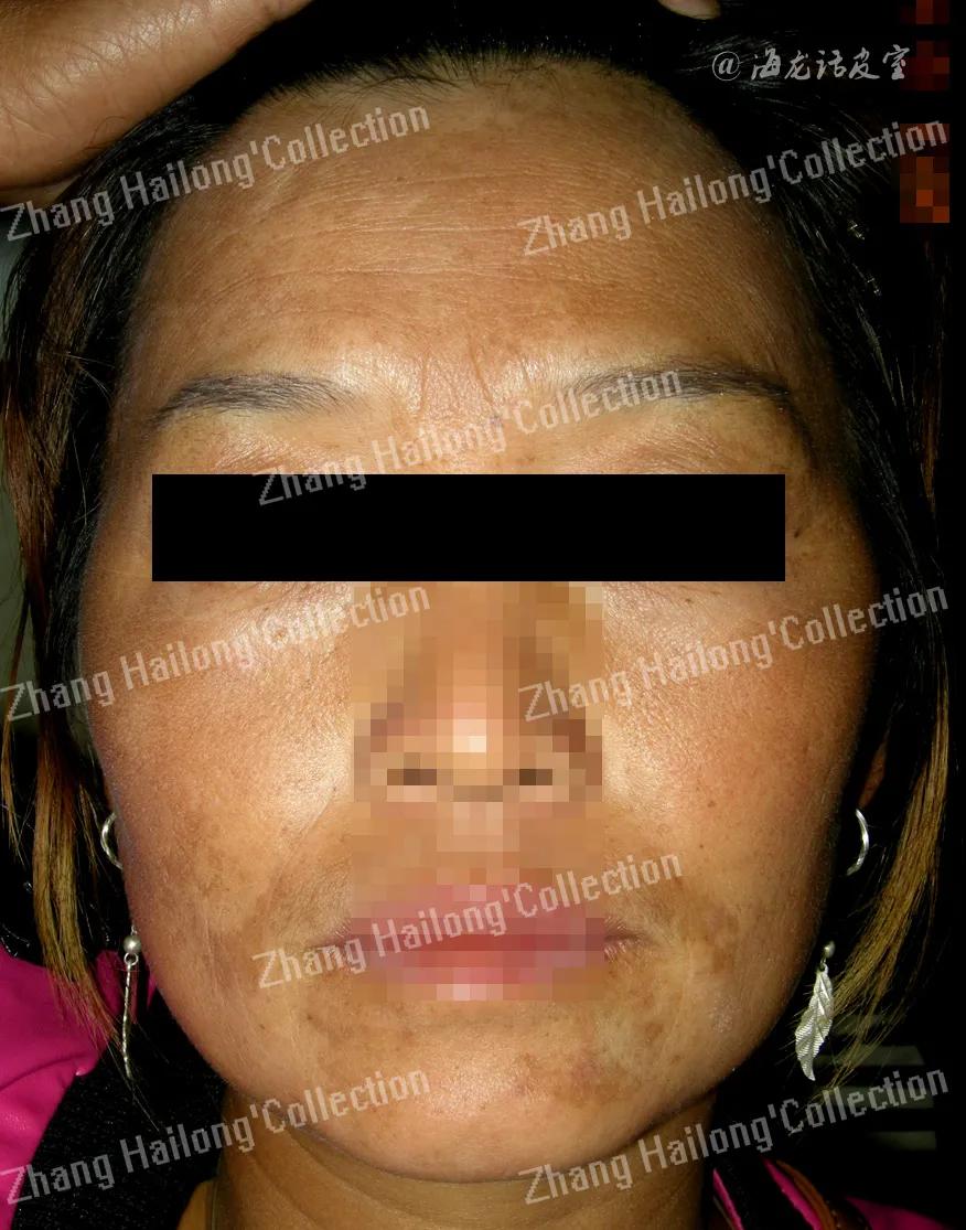 褐斑吃什么药能根除,除褐斑的办法