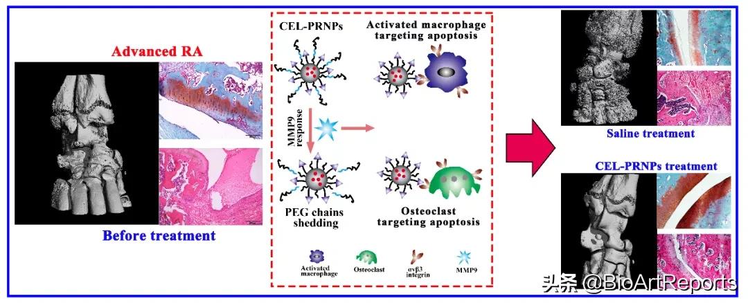 关节炎生物靶向制剂,类风湿关节炎生物制剂有新突破吗