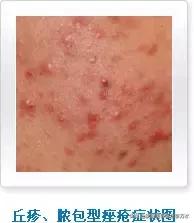 痘痘十大真相,痘痘大全图解