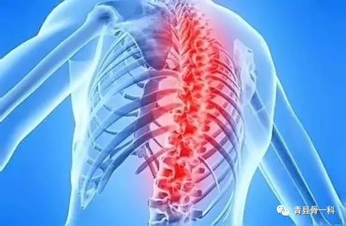 骨质增生就是骨刺？错，关于骨刺的治疗推荐3种常见方法