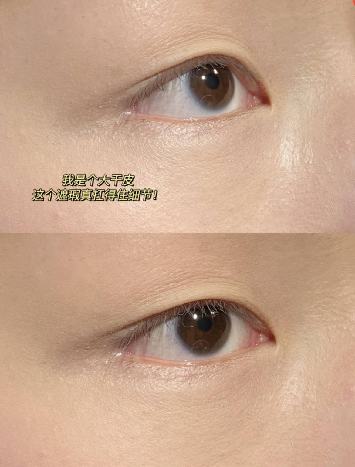 严重泪沟黑眼圈,淡化黑眼圈和泪沟原理