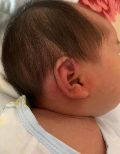 宝宝耳朵长了两个肉球想手术,小孩耳朵长肉疙瘩多大可以手术