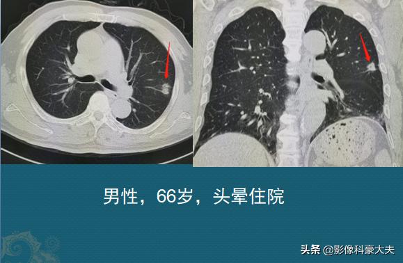 为什么腰部骨折要做心电图,骨折为什么要拍脑ct