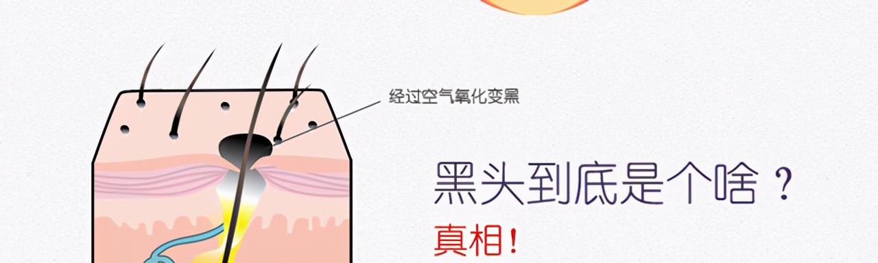 激光祛黑头真的可以去除吗,激光治疗黑头毛孔粗大多少钱