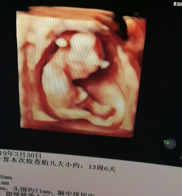 怀孕怎样看b超单子宫厚薄度,孕12周胎儿大小77*49mm正常吗