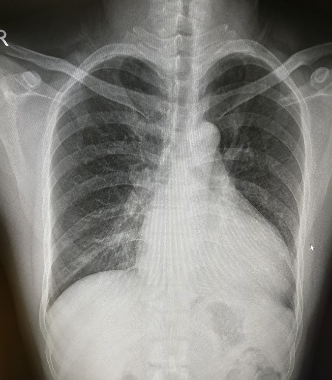 循环系统胸片,体循环和肺循环临床表现