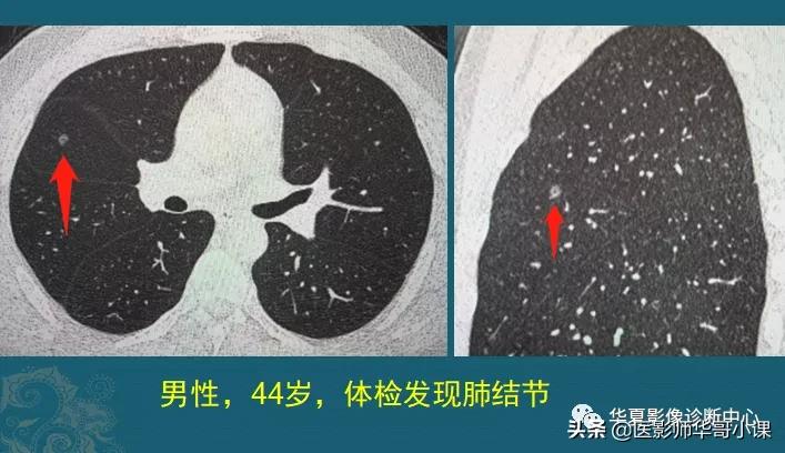 小细胞肺癌早期ct表现为什么结节,肺部ct显示有三处2cm结节是肺癌么