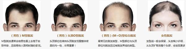 脱发谢顶发际线高,脱发谢顶补充什么营养