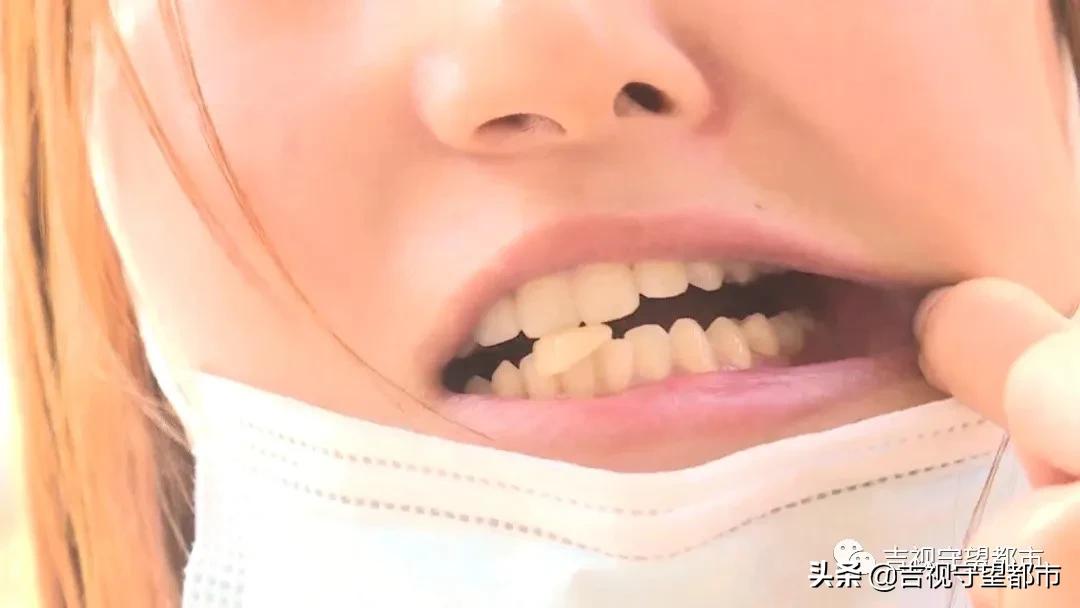 换了烤瓷牙异物感特别强,烤瓷牙多年后感觉吸冷空气牙酥酥