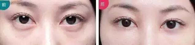 眼袋怎么消除简单方法男生,黑眼袋怎么消除最快方法男士