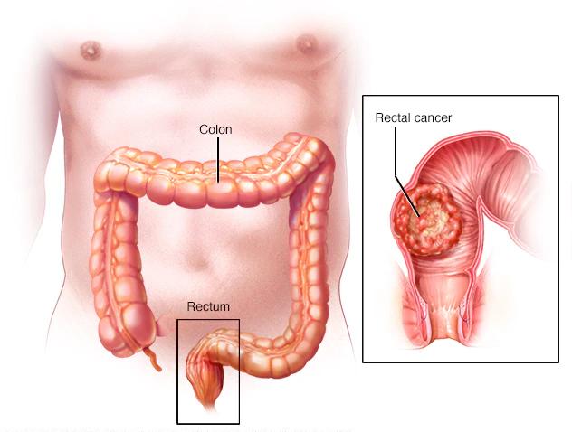 直肠息肉癌变会怎么样,直肠息肉0.2至0.3扁平息肉严重吗