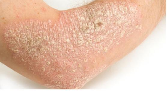 牛皮癣银屑病特效中药,牛皮癣的特效药膏有哪些