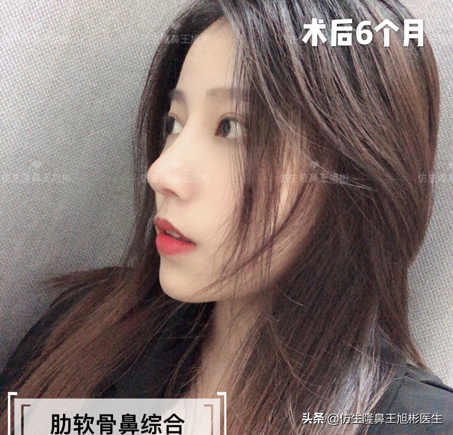 手术鼻头增厚能用什么方法弄,大鼻头高鼻梁缩小手术案例