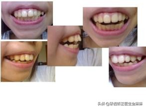 龅牙可以自己按压恢复吗,牙齿龅牙矫正的最佳年龄是几岁