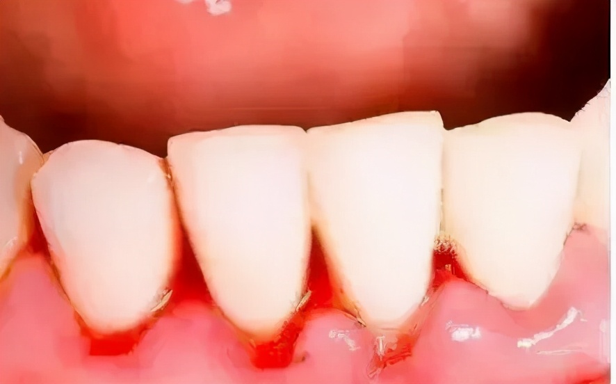 刷牙时牙龈出血要警惕,刷牙时牙龈出血的解决方法