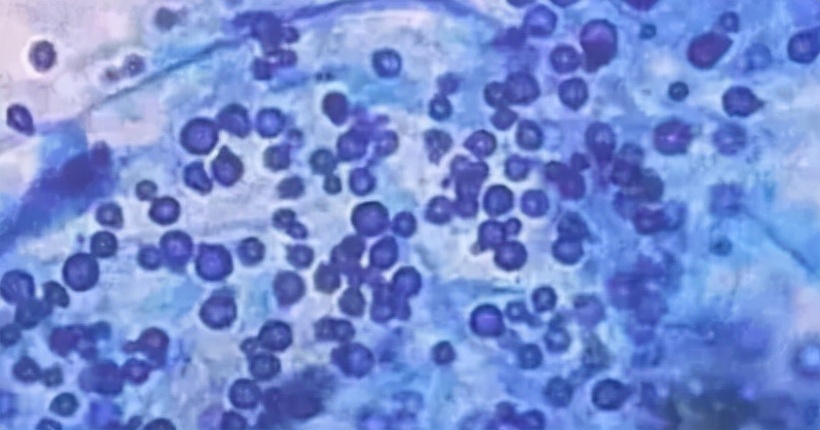 医生谈头痒头屑多用什么洗发水好,头屑头油彻底根治的洗发水