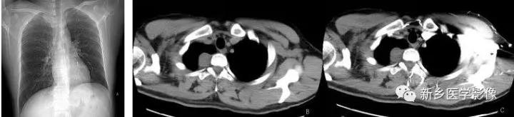 胸腺增生和纵隔肿瘤的区别和症状,纵隔胸腺肿瘤的常见临床症状表现