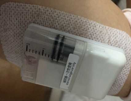 贴敷式胰岛素泵哪个好,胰岛素泵对比