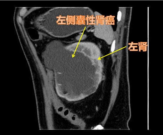 左肾囊肿伴钙化1cm手术要多少钱,肾囊肿5cm必须手术吗